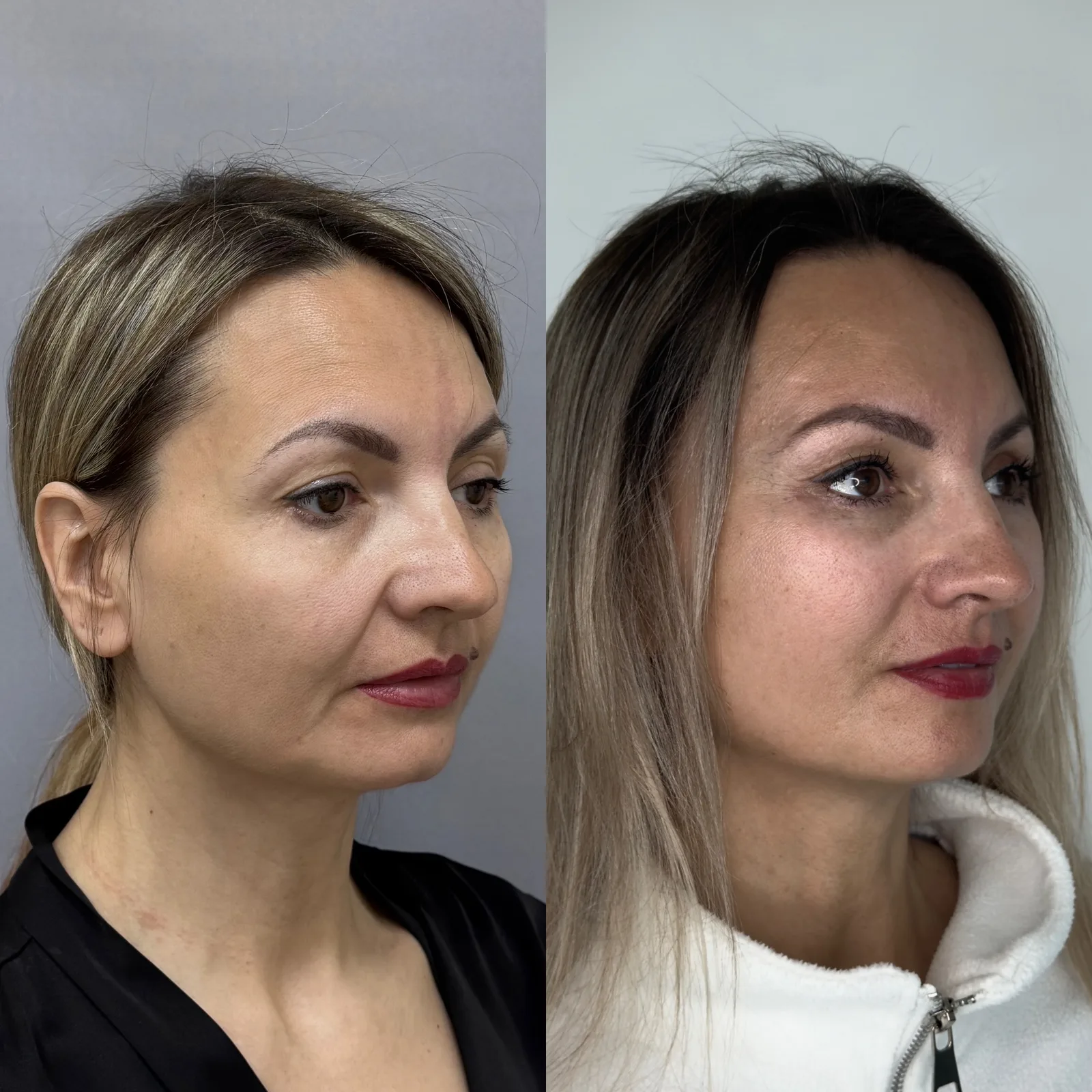 3 месяца после Эндоскопической бьютификации лица и нижней блефаропластик